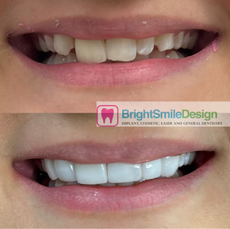 Dental Veneers in NYC 