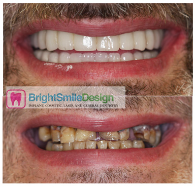 dental implants full mouth