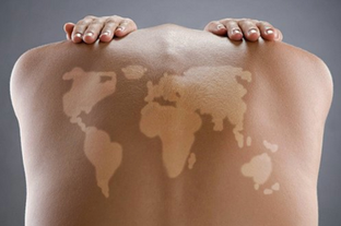 Long-Time-Liner Paris célèbre la Journée Internationale du Vitiligo !