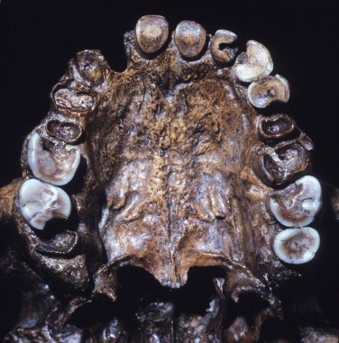 (Homo heidelbergensis) – detail horní čelisti s 10 zubními kazy.