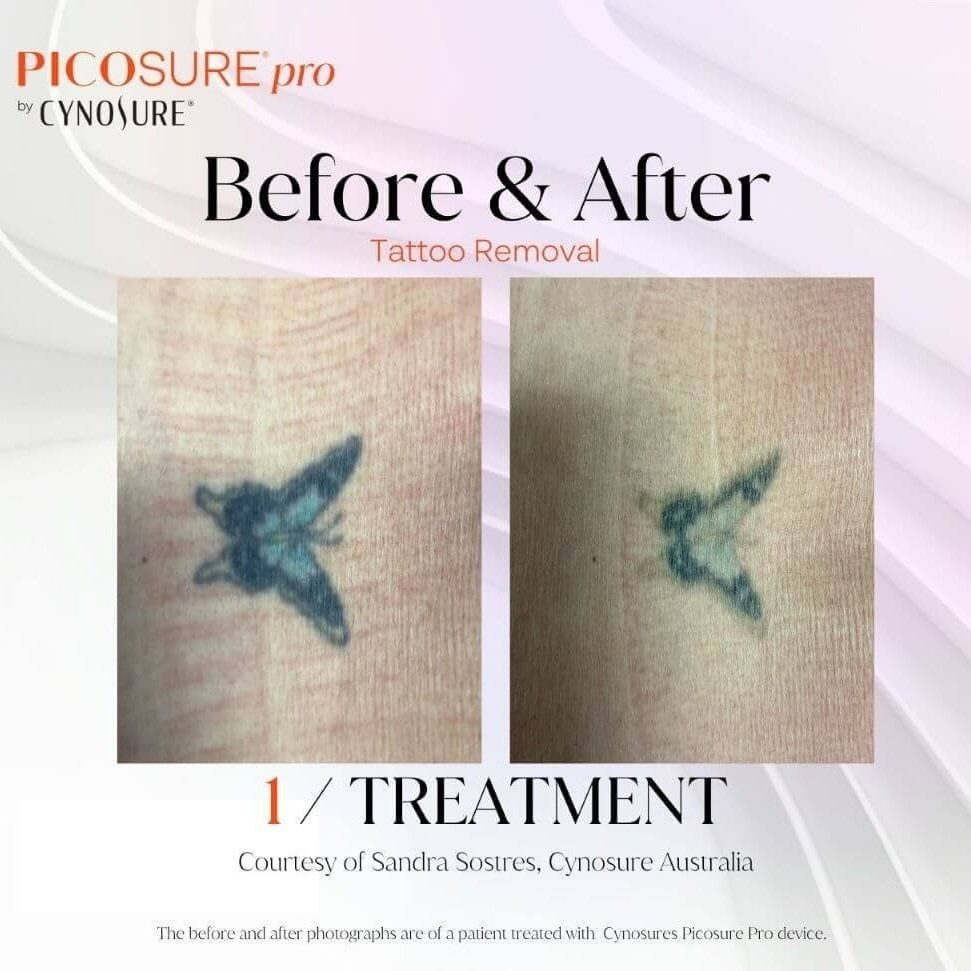 Tattoo Removal