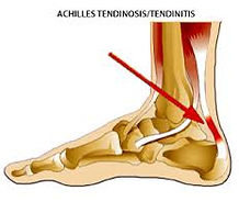 Achilles Tendinitis