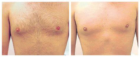 Thumbnail: MagicLaser Hair Removal