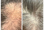 Hair Growth
