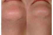 Laser Hair Removal