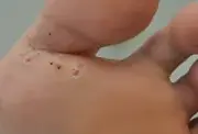 Wart & Skin Tags