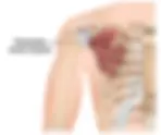 Pectoralis Minor Syndrome: An Overlooked Cause of Shoulder, Arm, and Nerve Pain