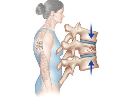 Osteoporosis results in compression fractures of the spine