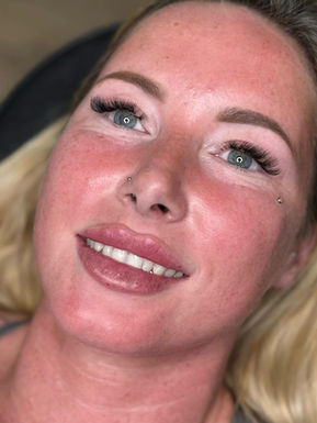 Lip Filler Sam Greenwood Aesthetics Yeovil