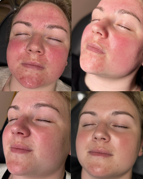 Acne treatment, Microneedling in Yeovil