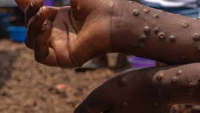 Ghana records 2 new Mpox cases