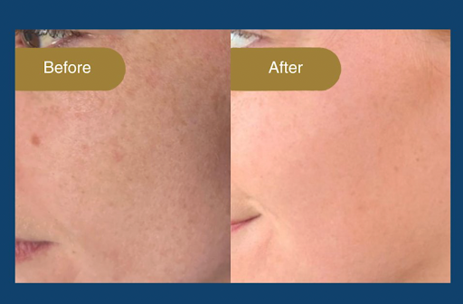 SQT Combination Skin Transformation: Before & After – What Results to Expect