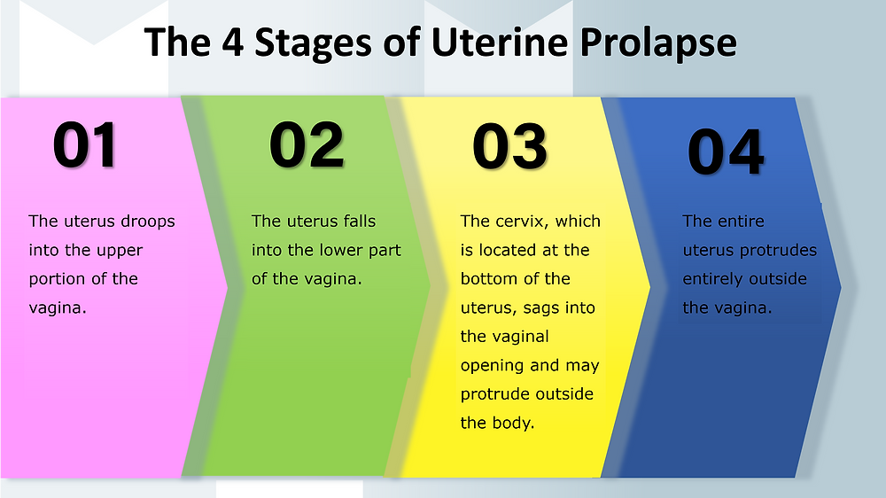 Infographic - prolapse stages - Stage 1 being mild and stage 4 being most severe