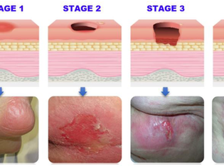 Understanding Pressure Ulcers: Diagnosis and Management