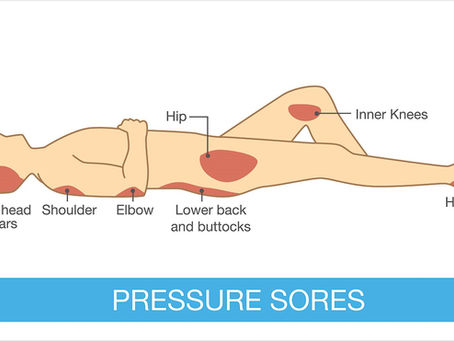 Understanding Bedsore Injuries in Nursing Homes