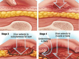 Are Bed Sores Always a Result of Nursing Home Negligence?