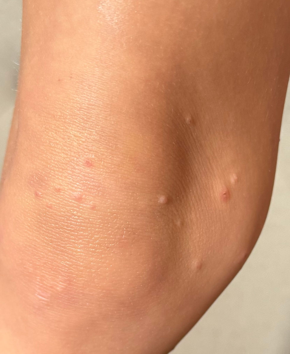 Understanding Molluscum Contagiosum: Causes, Treatment, and Prevention