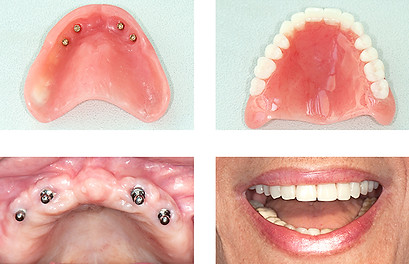 Four photos showing the stages of getting implant-supported dentures.