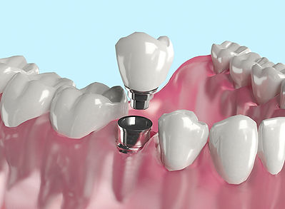Implant crown image showing the various parts.