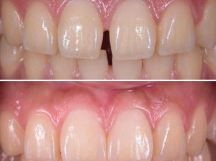 Smile Correction for Gaps Between Teeth: Can It Really Fix Your Smile?