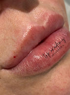 Lip Filler Burton On Trent