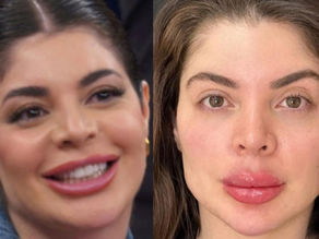 Pronta pra Farofa! Gkay passa por harmonização facial e antes e depois surpreende. Compare! 
