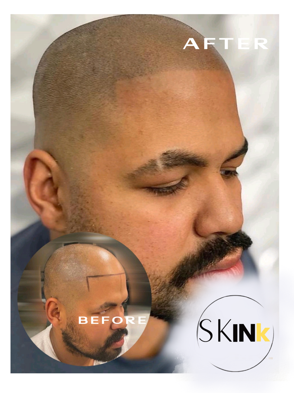 Scalp Micropigmentation Hair Line Blend