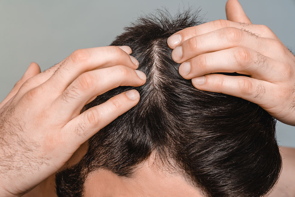 Closeup male dark hair. Head skin problems, receding hairline, alopecia, dandruff concept.