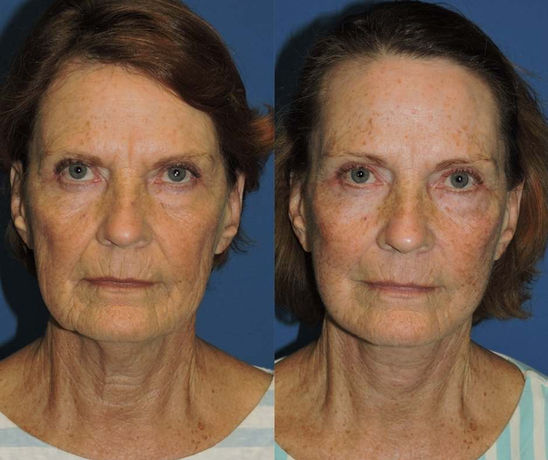 front view of a female neck lift