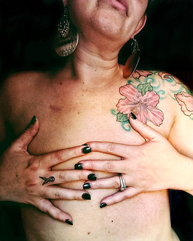 Flat Closure Now nonprofit organization for breast cancer and mastectomy patients in need of mastectomy pictures, patient stories, support and education on aesthetic flat closure, explant breast implants, and going flat.