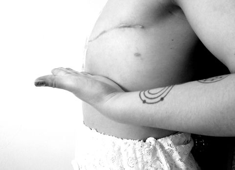 Flat Closure Now nonprofit organization for breast cancer and mastectomy patients in need of mastectomy pictures, patient stories, support and education on aesthetic flat closure, explant breast implants, and going flat.