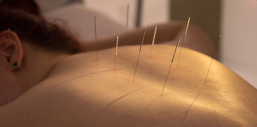 Acupuncture for Alpha Gal