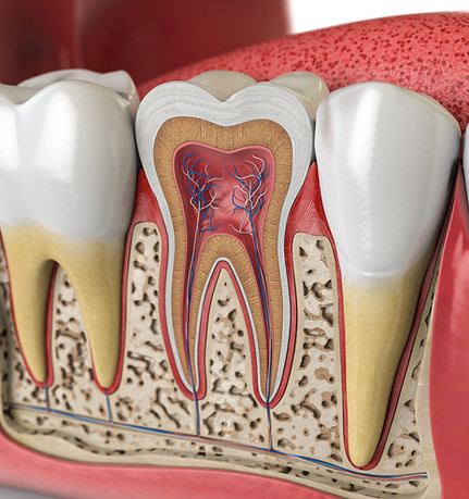 root canal