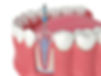 root canal