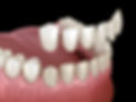 Veneer installation
