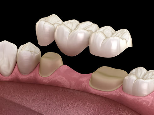 A dental bridge