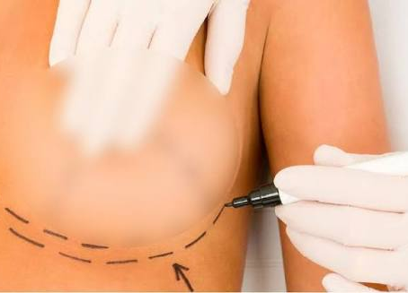 How Do You Choose the Right Breast Implant Size?