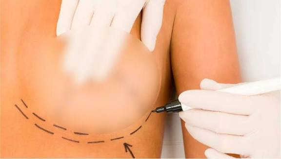 How Do You Choose the Right Breast Implant Size?