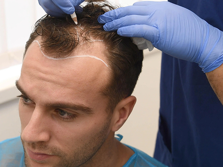 How Does Body Hair Transplant Compare FUE?