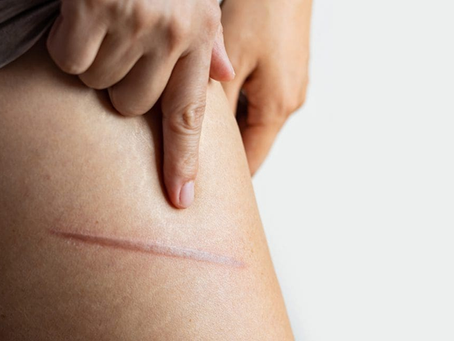 Can Facial Scar Revision Help Treat Burn Scars?