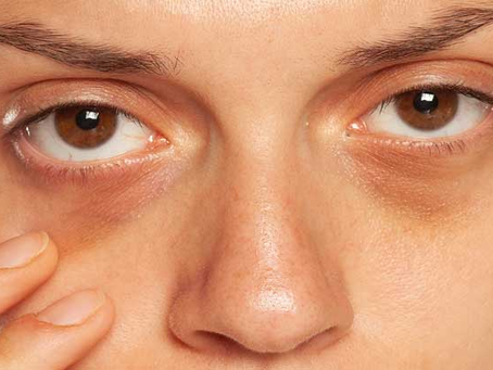 Is Dark Circles Treatment Permanent?