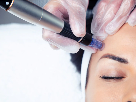 Does Microneedling Work for Under Eye Circles?