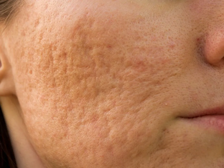Is Pimples Treatment Right for Dry Skin?