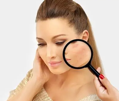Can Facial Scar Revision Improve Burn Scars?