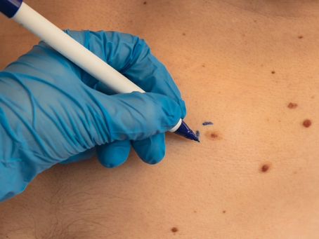 Do Skin Tags Grow In Private Body Areas?