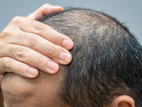 Can Women Safely Undergo Hair Transplant Procedures?