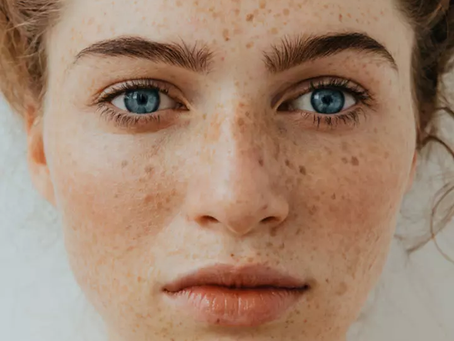 What Is The Best Freckles And Blemishes Treatment?