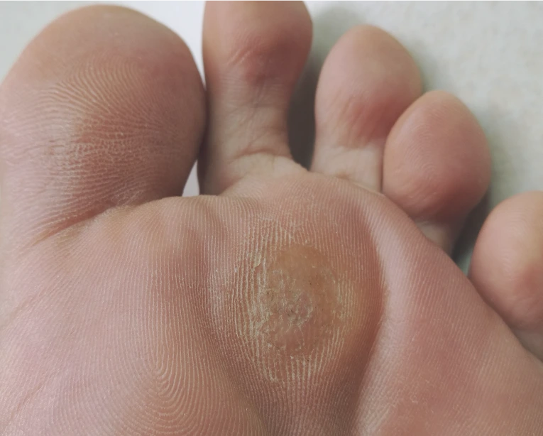 Are Wart Removal Treatments Safe?