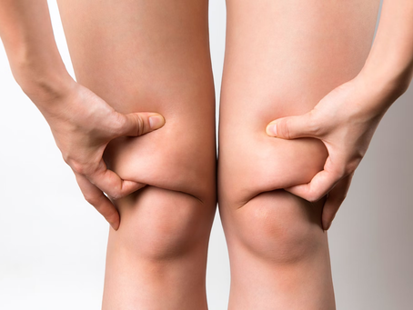 Is Sculpsure Body Contouring Suitable For Reducing Knee Fat?