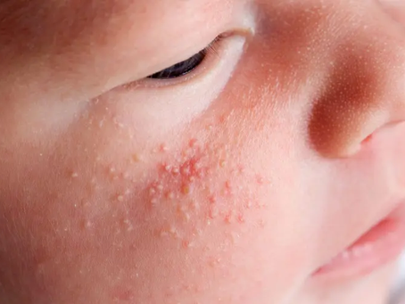 Are Milia Treatments Safe for Children?